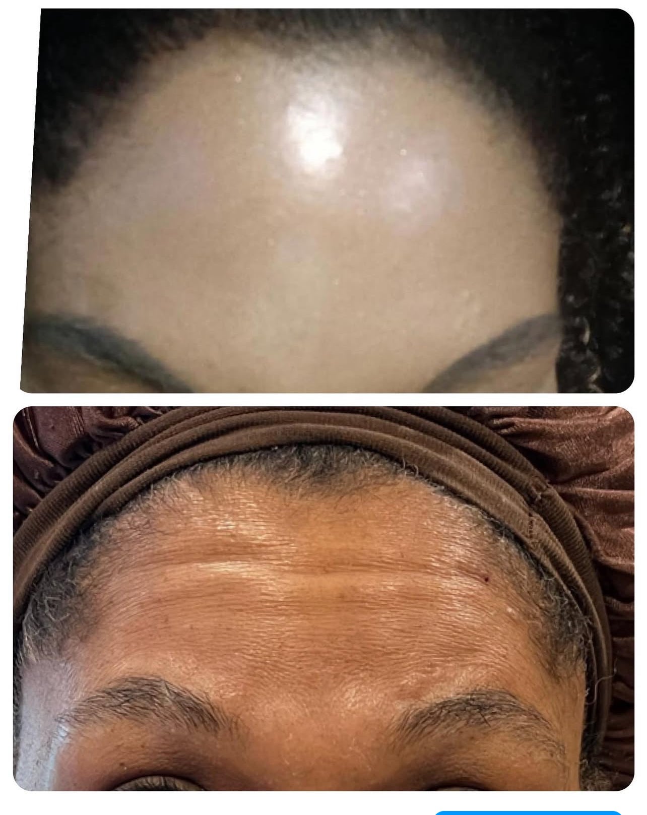 24 unit of Botox and 10mls Lemon Lipo Fat Dissolve