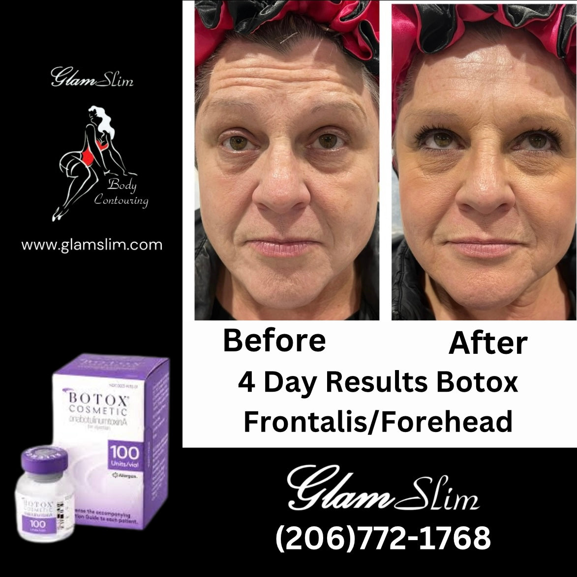 24 unit of Botox and 10mls Lemon Lipo Fat Dissolve