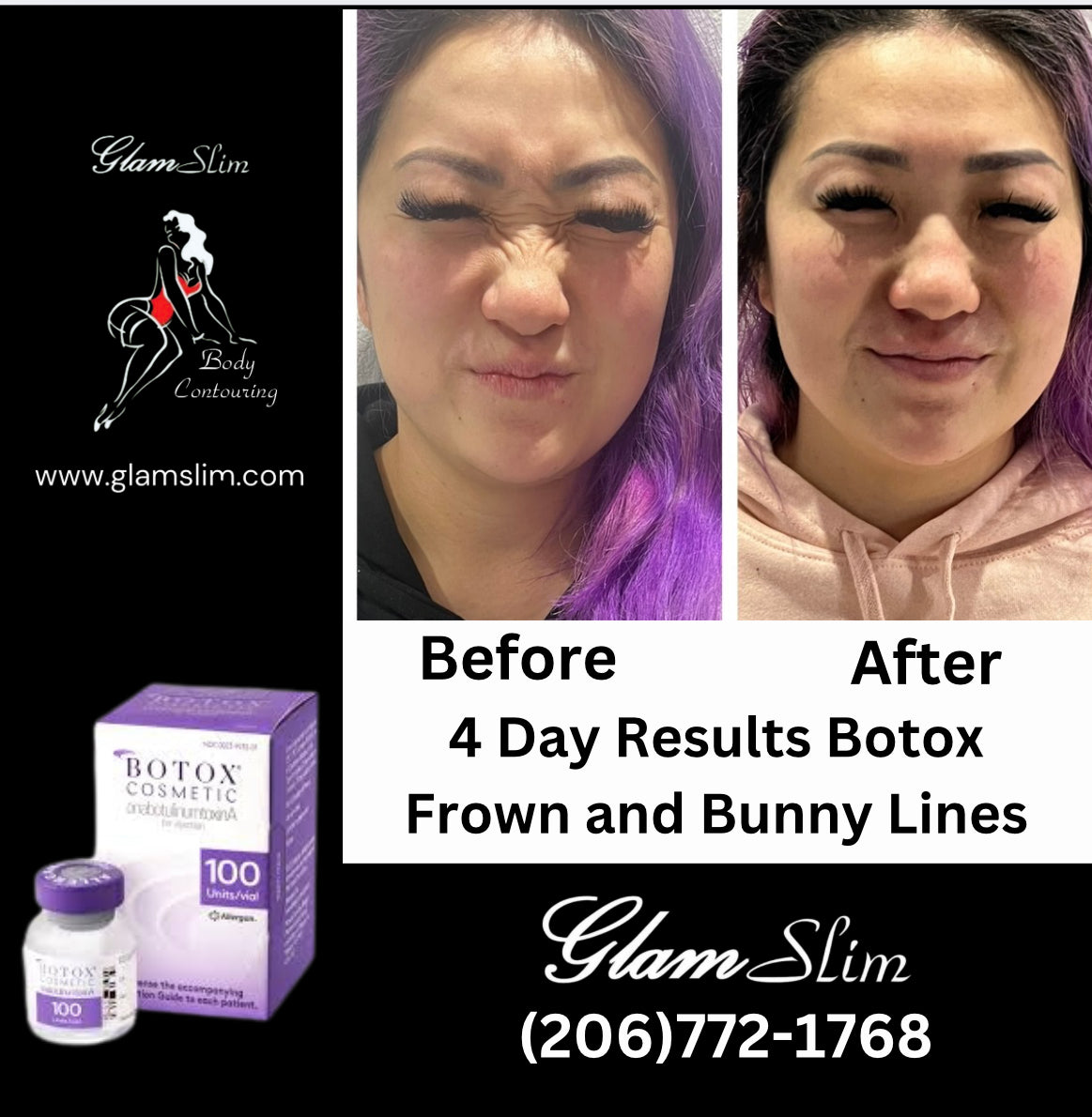 24 unit of Botox and 10mls Lemon Lipo Fat Dissolve
