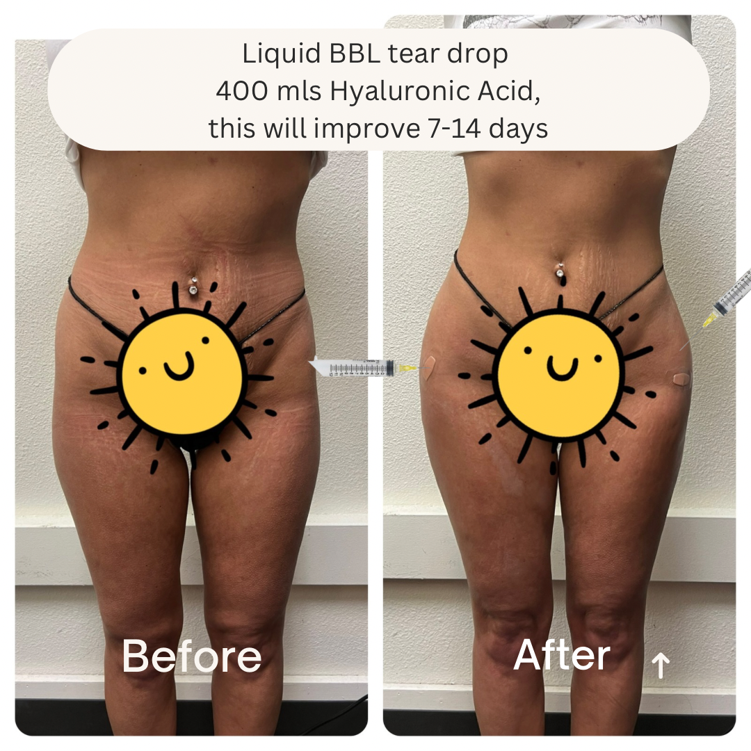 Liquid bbl Max Out