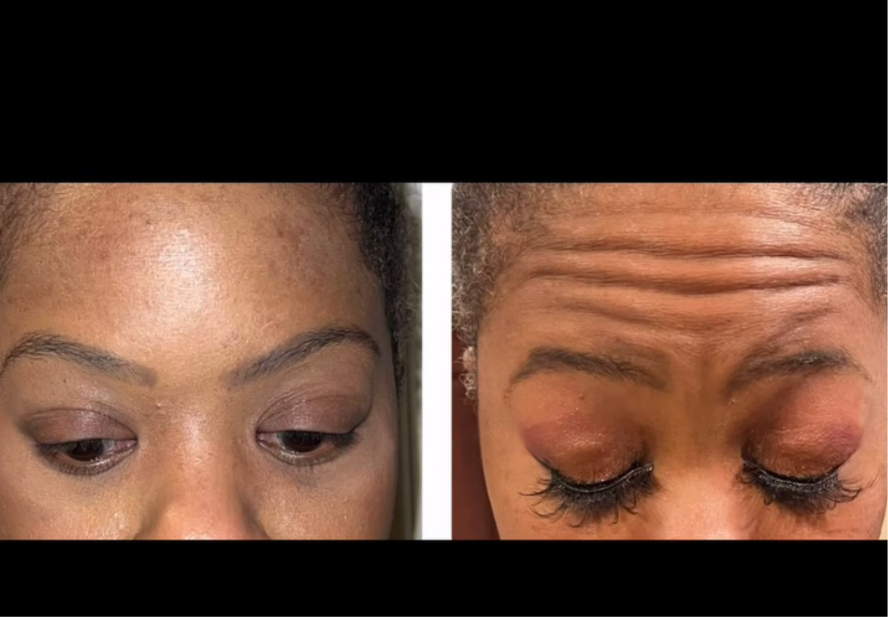 24 unit of Botox and 10mls Lemon Lipo Fat Dissolve