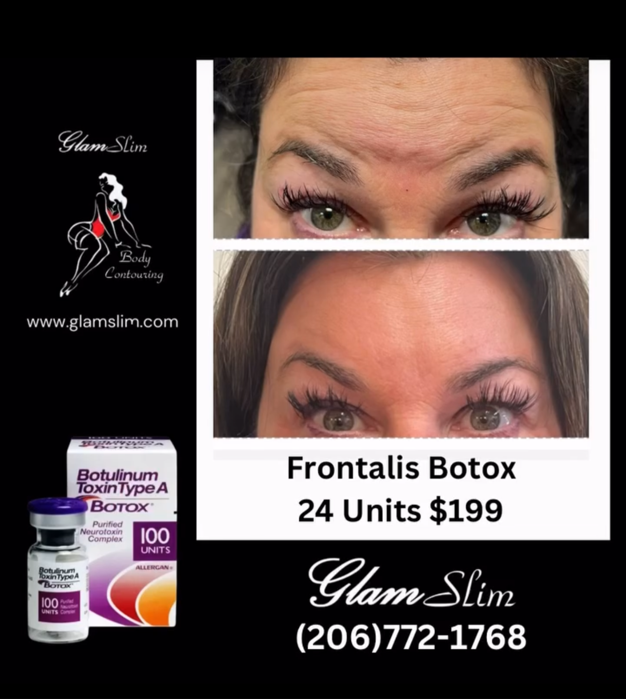 24 unit of Botox and 10mls Lemon Lipo Fat Dissolve